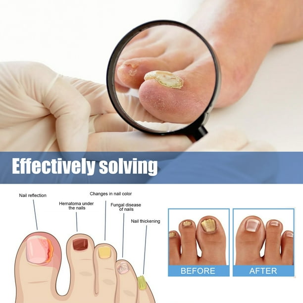 FUNGUS 完売間近！！ XIMONTH Nail Fungus Treatment for Toenail, 32 Pcs Nail Repair