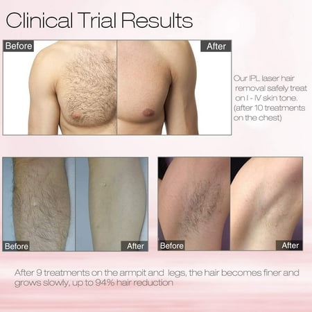Get At Home Ipl Hair Removal Before And After Background