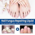 thumbnail image 2 of Tratamiento para hongos en las uñas de los pies, kit de 30 ml para tratamiento de hongos en las uñas de los pies de máxima potencia, 2 of 4
