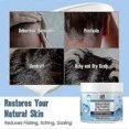 thumbnail image 1 of Seborrheic Dermatitis Cream, Anti Fungal Shampoo, Scalp Treatment For Psoriasis, Folliculitis, Dry Scalp, Anti-itch, Sooth, 1 of 4