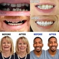 thumbnail image 2 of Dientes artificiales Dentaduras Temporales Prótesis dentales rápidas Carillas de sonrisas perfectas, Repare su diente rápidamente, Haga que sonría con confianza Adepaton LKX-1380, 2 of 7