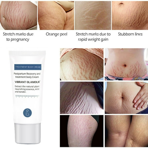 How Do I Permanently Get Rid of Stretch Marks?