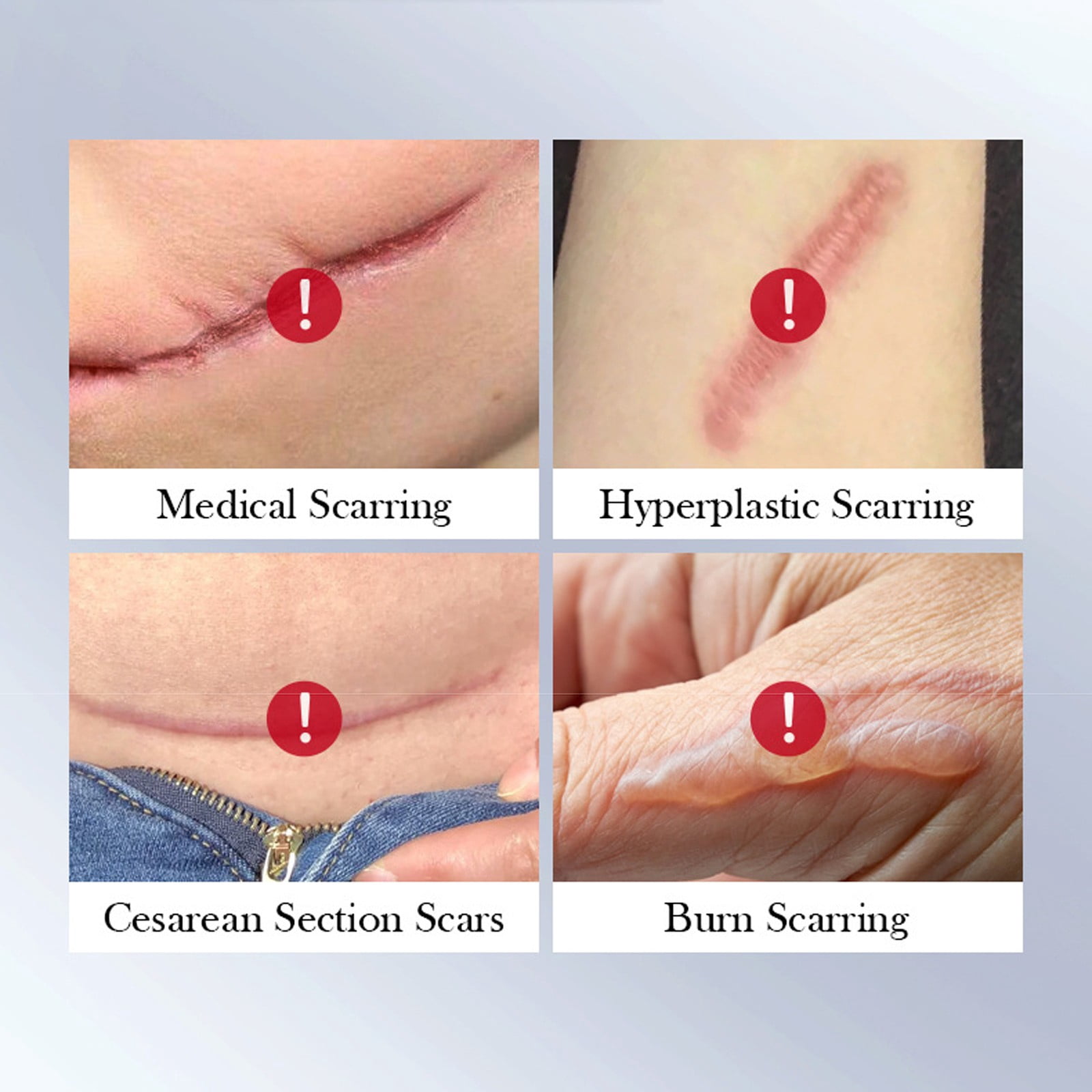 Scar Cream for Cream New And Old Hypertrophic Keloids Caused By General Trauma Burns Reduction Enhance Skin Smoothness All Skin Types Medical 20g