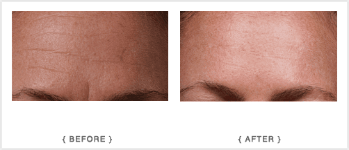 SilcSkin Full Face Set