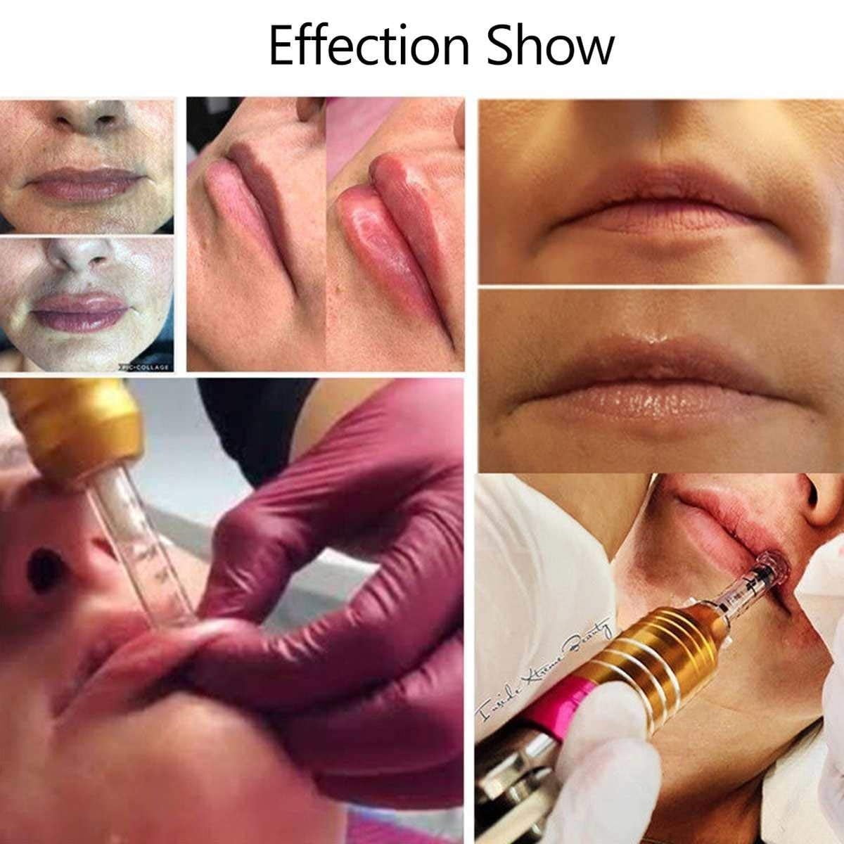 needleless lip filler needleless lip filler