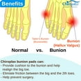 thumbnail image 6 of Chiroplax Bunion Corrector Relief Cushion Pads Guard Toe Separator Straightener Splint Protector Shield Spacer Sleeve Cover Hallux Valgus (4 Pads w/ Shims, Large), 6 of 7