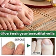 thumbnail image 4 of 1-3X Essential Oil Nail Fungus Repair Liquid Nail Thickening Discoloration Off Soft Nail Thickening Type Onychomyc 20ml, 4 of 5