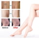 thumbnail image 1 of South Moon 10Pcs Veins Varicose Patches Relieve Phlebitis Angiitis Improve Varicosity Soothing Leg Swelling Pain, 1 of 5