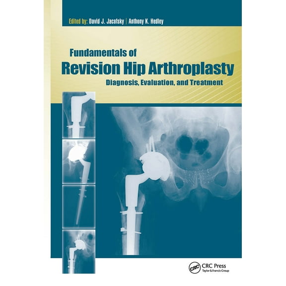 Fundamentals of Revision Hip Arthroplasty: Diagnosis, Evaluation, and Treatment, (Hardcover)