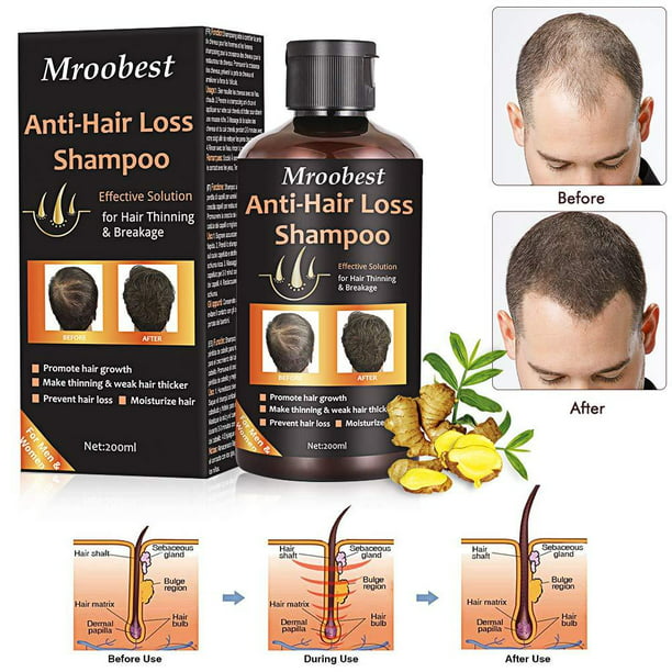 Anti-Hair Loss Shampoo, Hair Regrowth Shampoo, Natural Old Ginger Hair ...