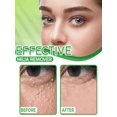 Eye Milia Removal Cream