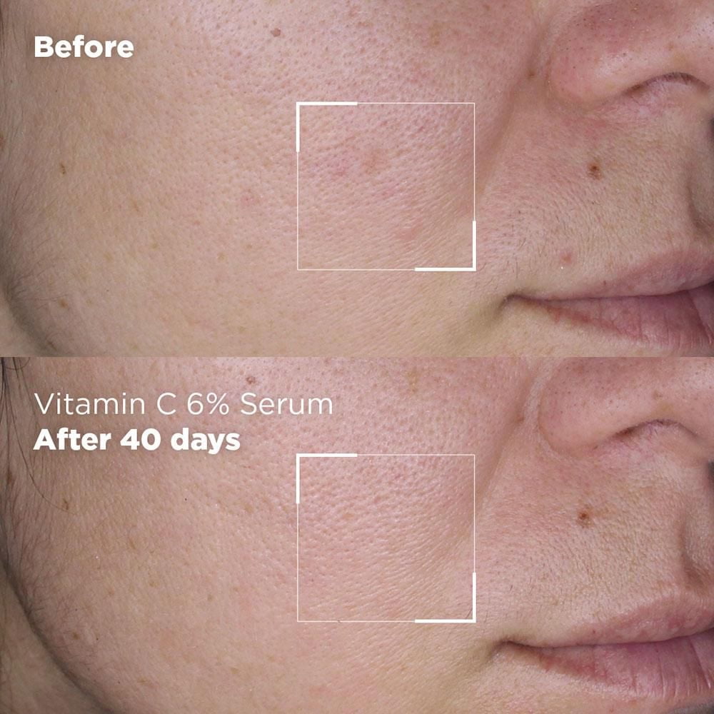 Vitamin C Skin before And After: Stunning Transformations Revealed