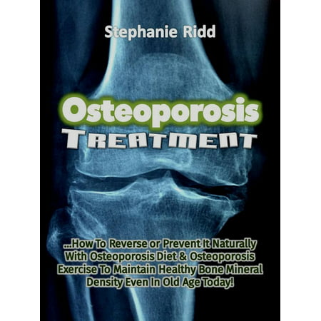 Osteoporosis Treatment: How to Reverse Or Prevent It Naturally With Osteoporosis Diet and Osteoporosis Exercise to Maintain Healthy Bone Mineral Density Even In Old Age Today! -
