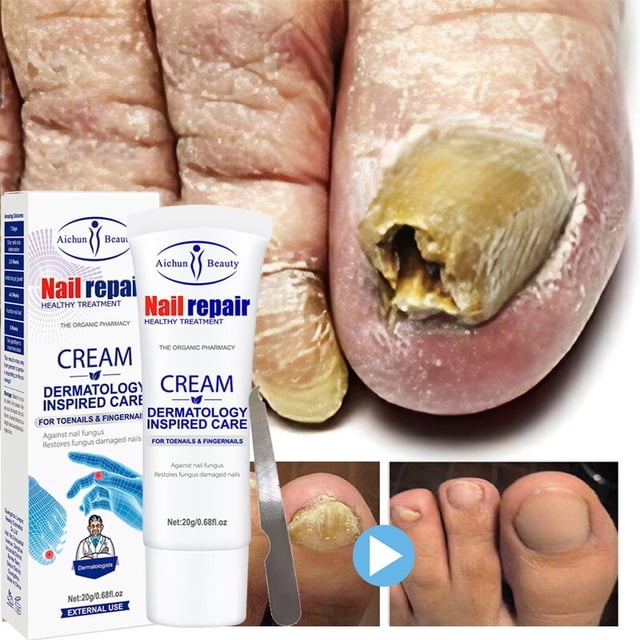 Crema eficaz Casa de los Tesoros Tratamiento de hongos en las uñas Gel antiinfección 20g