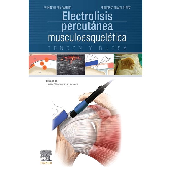 Electrolisis Percutánea Musculoesquelética. Tendón Y Bursa Blanco