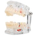 thumbnail image 3 of Modelo de enseñanza de dientes Modelo de patología Modelo patológico Estudio de enseñanza dental Modelo de dientes de demostración para laboratorio dental Investigación hospitalaria Dientes anatómicos, 3 of 9