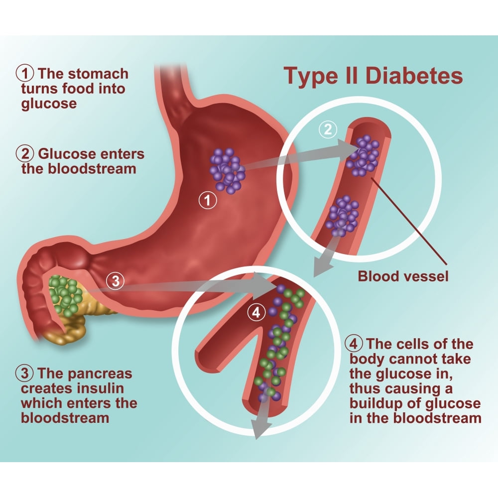 Type 2 Diabetes Poster Print by Gwen ShockeyScience Source Walmart