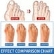 thumbnail image 3 of Corrector de 2 piezas para mujeres y hombres, banda elástica para dedos del pie Valgus Brace - Dedo ortopédico ligero, cómodo y transpirable, 3 of 5