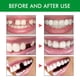thumbnail image 3 of Kit Dental Temporal Kuymtek Reparación Dientes, 3 of 9