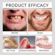 thumbnail image 5 of Juego avanzado de carillas dentales cosméticas de silicona compatibles con Smile, 5 of 5