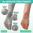 thumbnail image 6 of Patchology PoshPeel Pedi Cure XL: Intensive Foot Peel Treatment Foot Mask, 1 Treatment/Box, 6 of 6