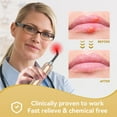 Red Light Therapy Device, Cold Sore Canker Sore Treatment for Lips