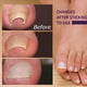 thumbnail image 4 of Parche corrector de uñas de los pies, pegatinas elásticas de corrección de uñas encarnadas, herramientas de pedicura, 4 of 10