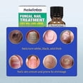 thumbnail image 2 of Toenail Fungus Treatment Extra Strength,Nail Repair Liquid Solution with Tea Tree Oil for Discolored and Damaged Nails, Nail Fungus Treatment for Men, 2 of 5
