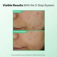 thumbnail image 2 of Limpiador StriVectin Multi-Action Clear Gentle 150 ml para el acné, 2 of 7
