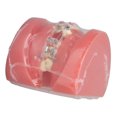 thumbnail image 4 of Modelo Dental de Ortodoncia ANGGREK Resina Desmontado, 4 of 7