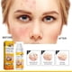 thumbnail image 5 of Crema de eliminación de acné quístico Ndcxsfigh 30ml reparación hidratante antiacné blanqueamiento, 5 of 9