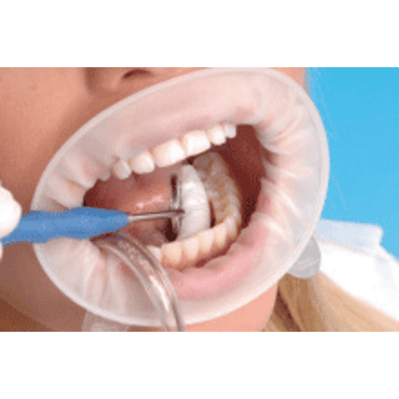 Ivoclar Vivadent 590850 OptraGate 3D Lip & Cheek Retractor Adult Regular 80/Bx