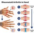 thumbnail image 3 of Bone Repair Gel Roller, Cooling Joint Pain Relief Roller - Natural Arthritis & Muscle Tension Repair for Shoulders, Neck, Back, Knees, 3 of 5