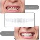 thumbnail image 2 of Sonrisa a presión en dientes postizos superior inferior carillas dentales dentaduras conjunto de cubierta de dientes, 2 of 5