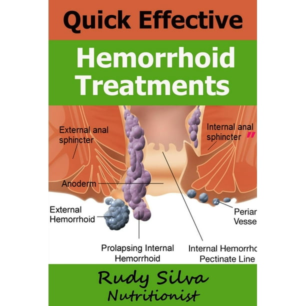 Quick Effective Hemorrhoid Treatments eBook