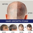 thumbnail image 2 of Hair Growth Foam Spray Anti Hair Loss Treatment Hair Regrowth for Men, 2 of 5