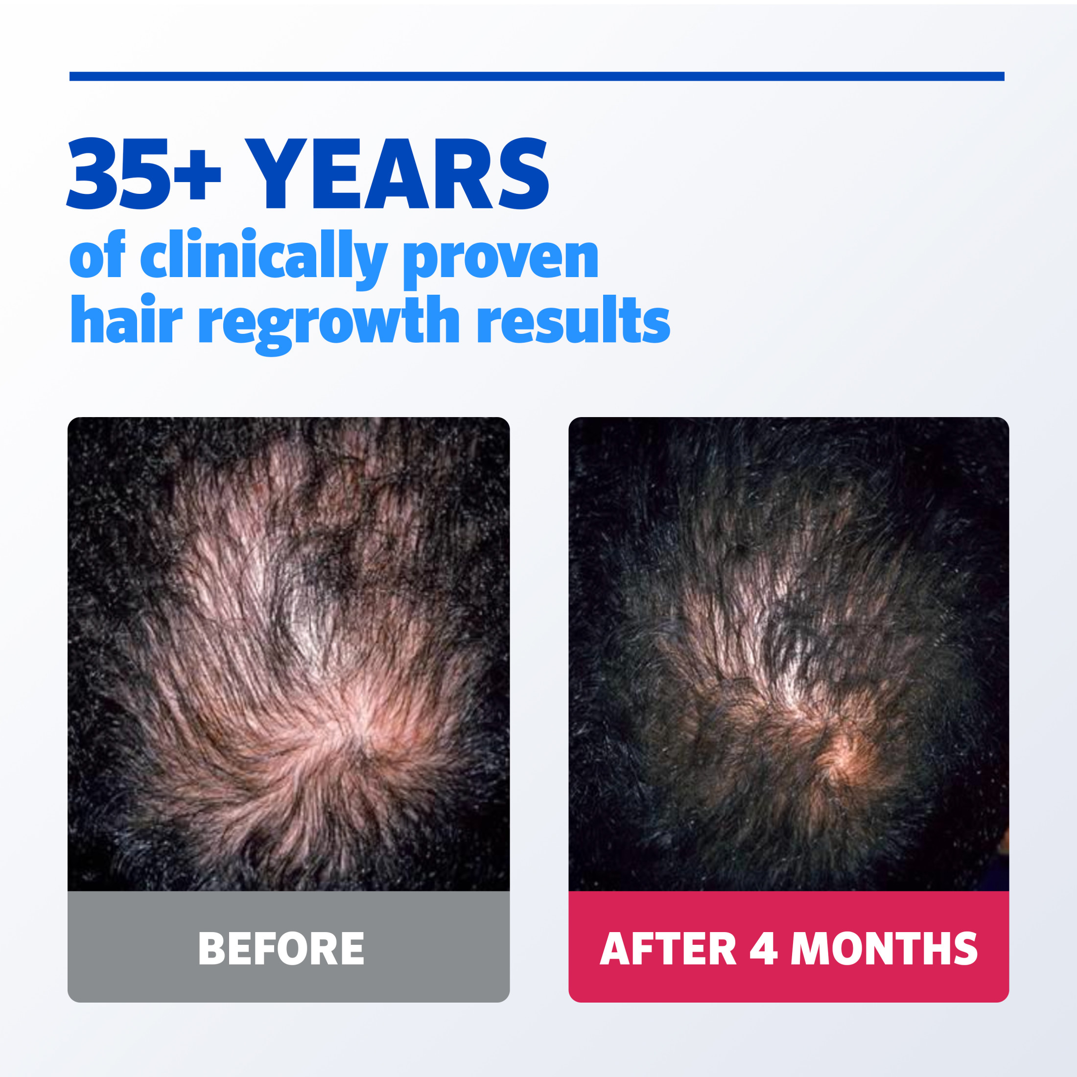 HEALMUSZ Extra Strength Hair Regrowth Serum For Men – 10 Month Supply, Minoxidil Formula, Almond Scent, Alcohol Free