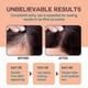 thumbnail image 2 of 2025 New Honex Anti Snoring Mouthpiece, The Quite Night Anti snoring Device, Mouth Guard for Women and Men, Soft and Comforta, 2 of 5