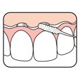 thumbnail image 4 of TEPE Bridge Implant Dental Floss - Thick, Flexible with Stiff Ends for Braces, 5 Pcs, 4 of 5