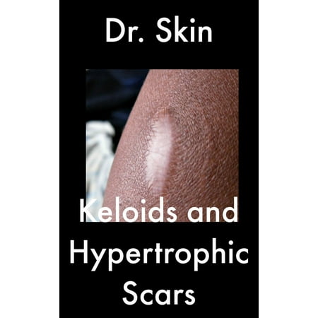 Keloids and Hypertrophic Scars - eBook (Best Treatment For Keloids)