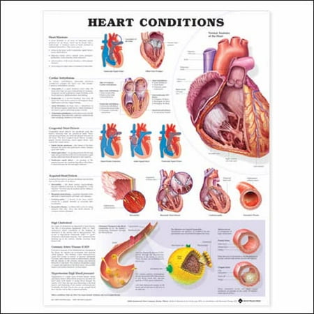 Heart Conditions Anatomical Chart: (unmounted)