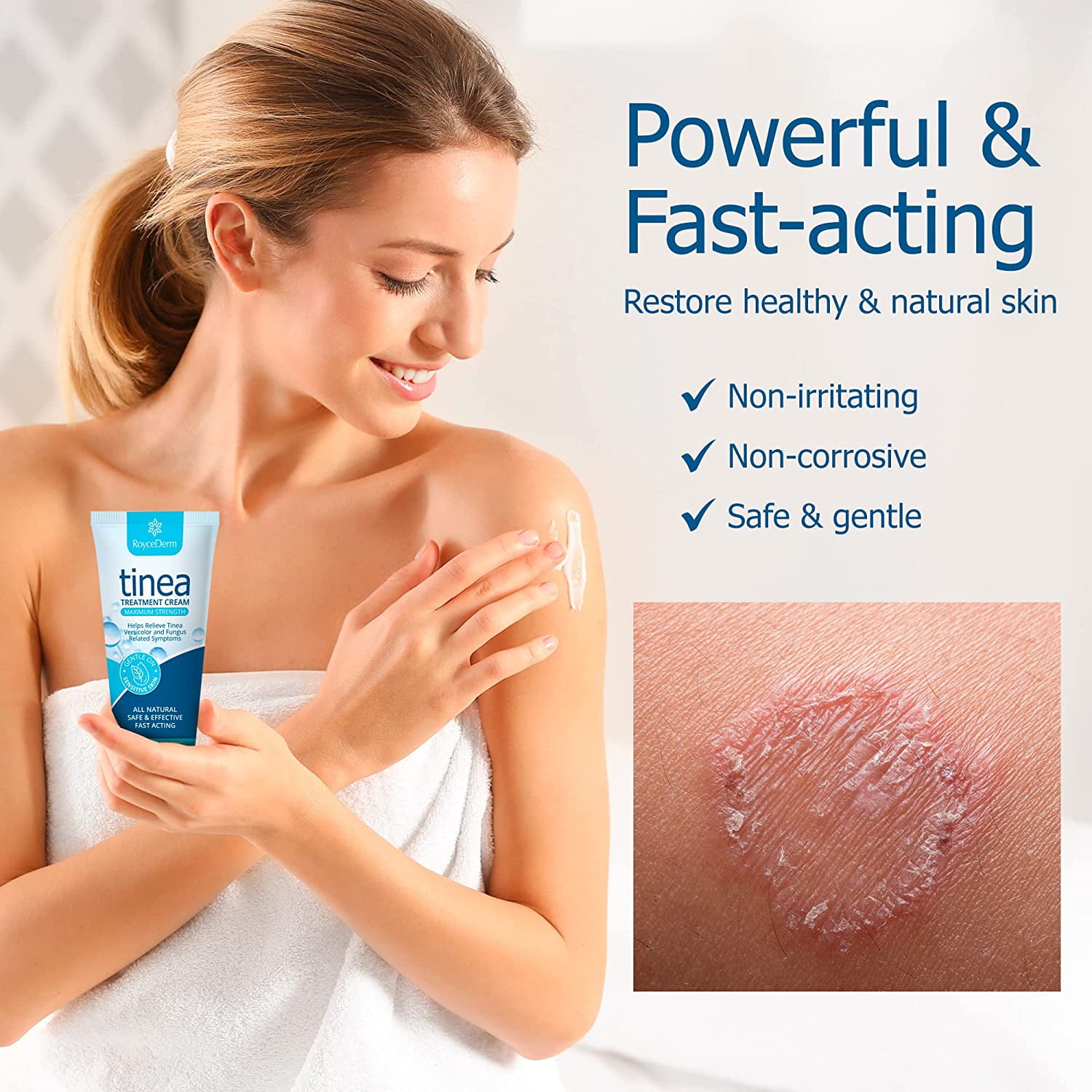 Roycederm Tinea Versicolor Treatment, Athletes Foot Treatment, Ringworm Treatment for Humans, for Tinea Versicolor & Pedis,Fast Healing Anti Fungal Skin Cream