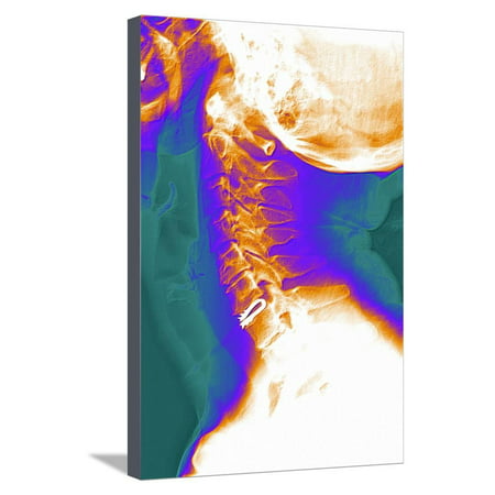 Artificial Cervical Disc, X-ray Stretched Canvas Print Wall Art By (Best Artificial Cervical Disc)