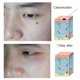 thumbnail image 5 of Dispositivo de belleza para eliminar manchas y lunares, 5 of 8