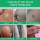 thumbnail image 4 of Corn Removal Extra Strengthen Gel Foot Callus Removal Treatment Hard Skin Js, 4 of 5