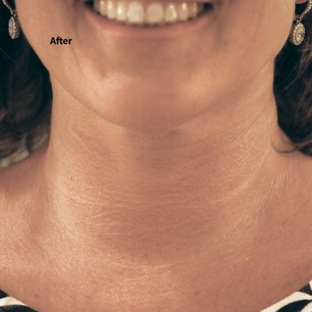 Women's Neck Tite Magic