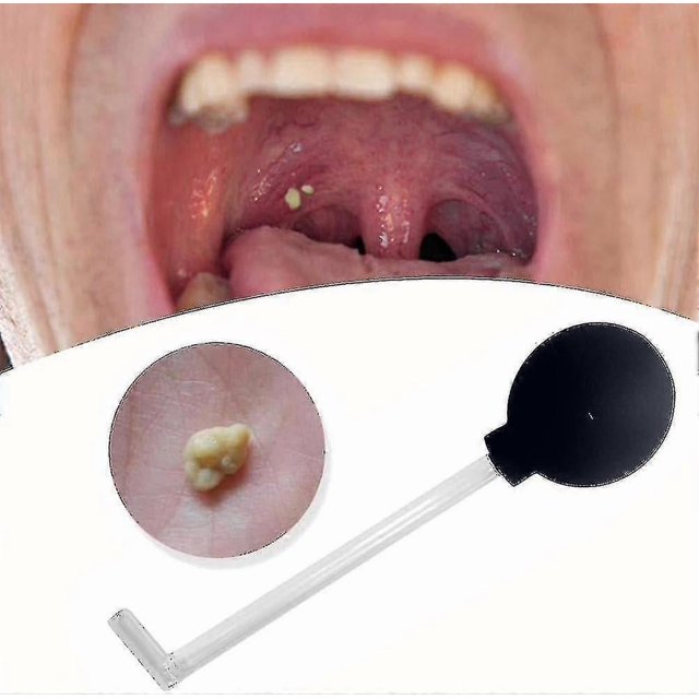 Tonsil Stone Remover Vacuum, Tonsil Stone Removal Kit Tool Tonsil Stone Treatment Oral Suction Tool, Dental Suction Mouth Cleaner Mouth Cleaning Oral