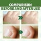 thumbnail image 3 of Molluscum Thuja Warts Homeopathy Cream Molluscum Contagiosum In Children Adults, 40% Off, 3 of 3