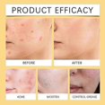 thumbnail image 3 of Bee Venom Anti-Wart Cream, Bee Venom Skin Restoration Cream, Bee Venom All-in-One Repair Cream for Face & Body, 3 of 5