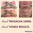 thumbnail image 2 of Prosacea - Cura la rosácea Síntomas de enrojecimiento, espinillas, 2 of 2
